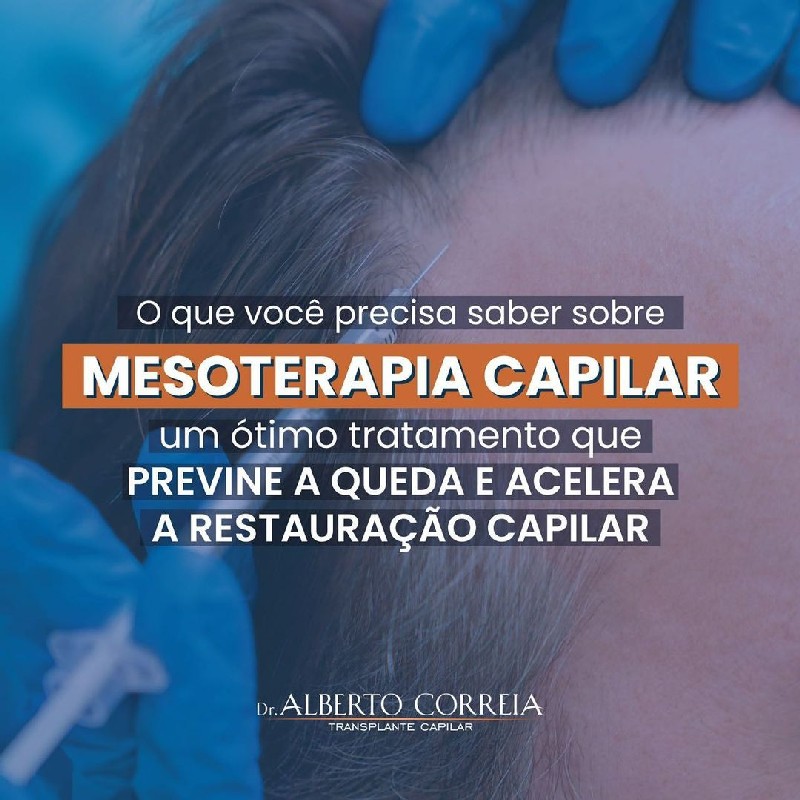 Mesoterapia capilar para alopecia androgenética