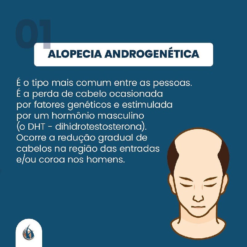 Tratamento alopecia androgenética masculina