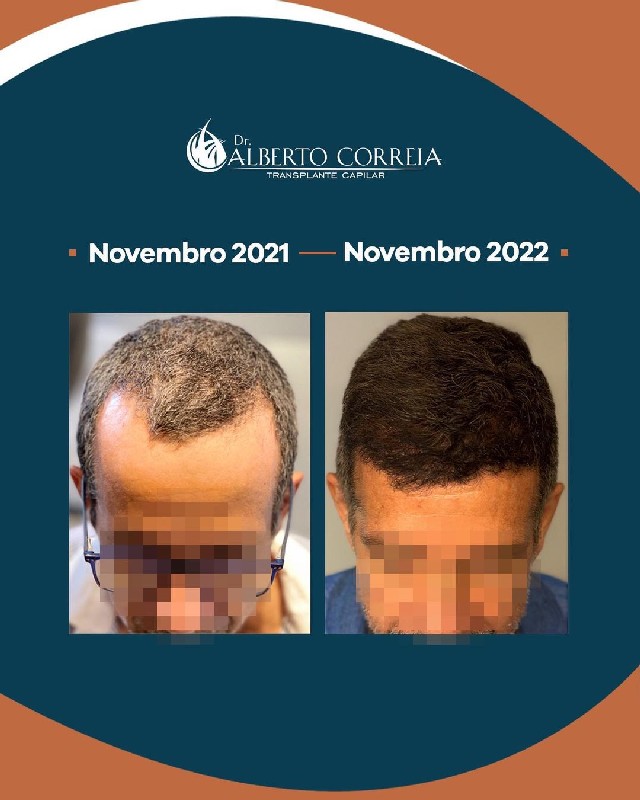 Tratamento capilar para alopecia androgenética